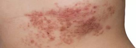 Typischer Hautausschlag bei Gürtelrose Typischer Hautausschlag bei Gürtelrose