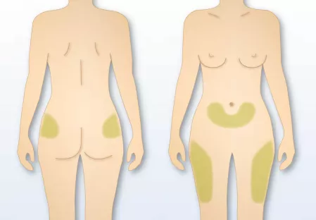 STANDL Diabetes Körper-Grafik STANDL Diabetes Körper-Grafik