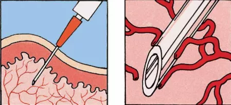 Insulin spritzen Grafik