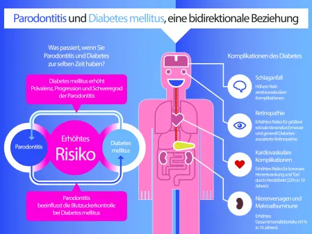 Schaubild Parodontitis und Diabetes
