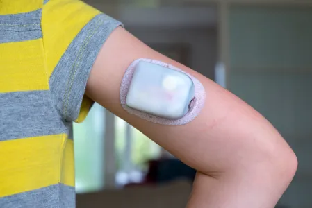 Patch-Pumpe an Kinderarm Omipod Pumpe an Kinderarm