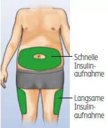 Insulininjektion: Injektionsbereiche Insulininjektion: Injektionsbereiche