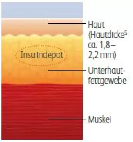 Insulininjektion: Unterhautfettgewebe Insulininjektion: Unterhautfettgewebe