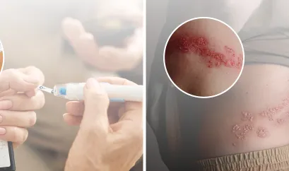 Diabetes und Gürtelrose